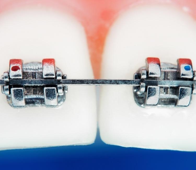 Braces 101: What To Do If Your Bracket Falls Off