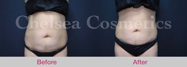 Coolsculpting Can Give You The Figure You Want
