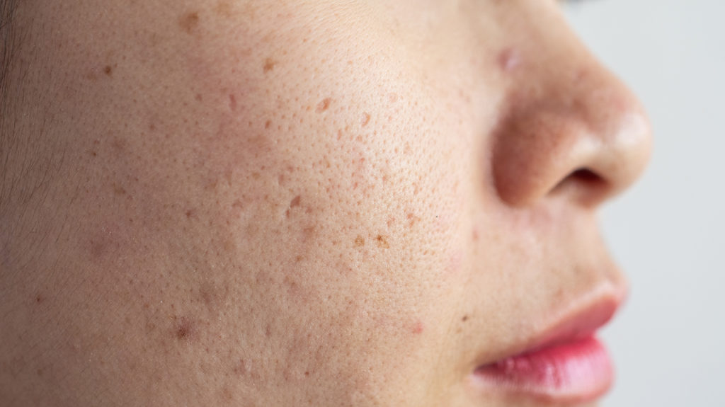 HOW TO REDUCE PIGMENT SPOTS?