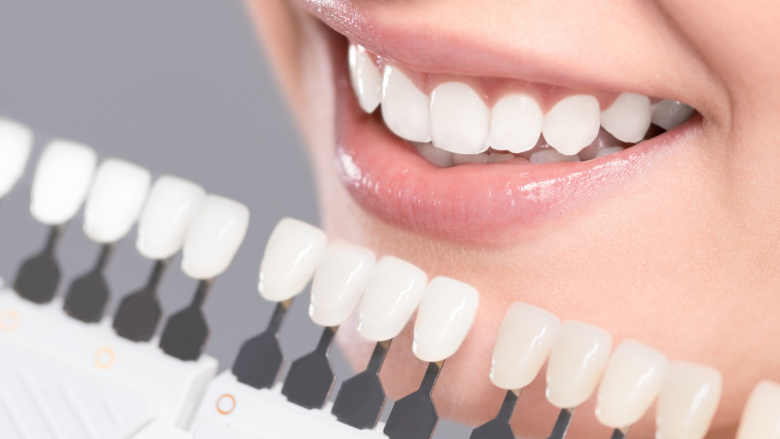 The Truth About Teeth Whitening Kits: Are They Really Worth It?